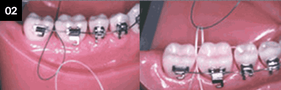 치실 사용법