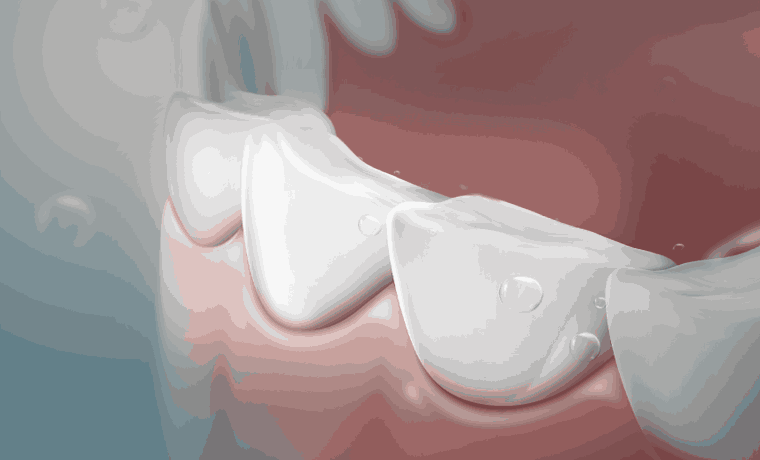 마모된 치아의 보철수복