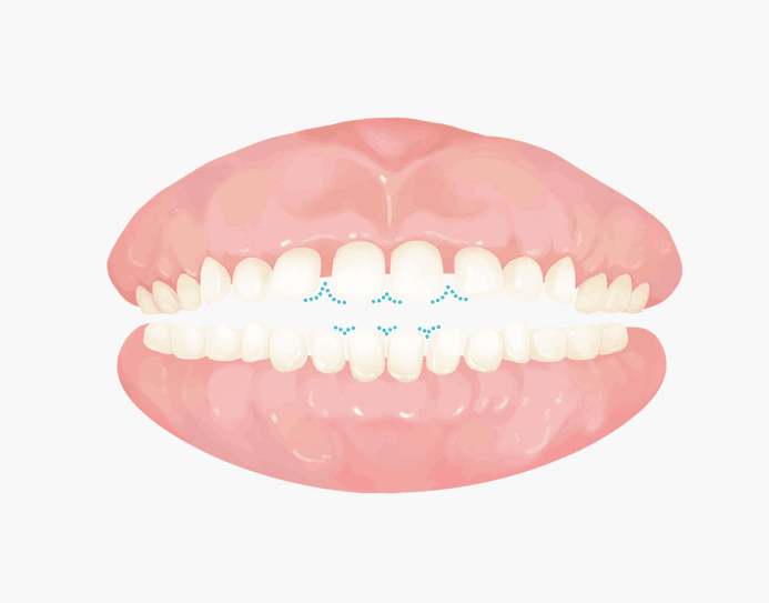 벌어진 치아