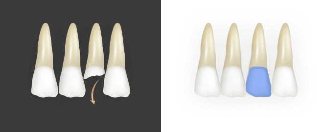 파절된 치아