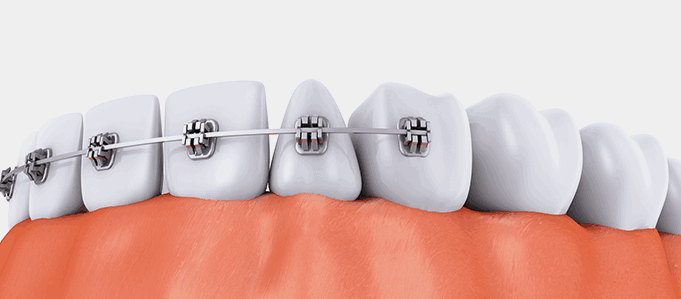 치아교정기 장착 칫솔질 교육