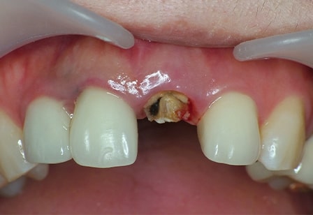 치아파절 재시술