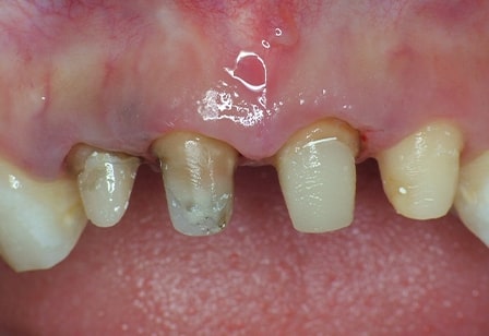 치아파절 재시술