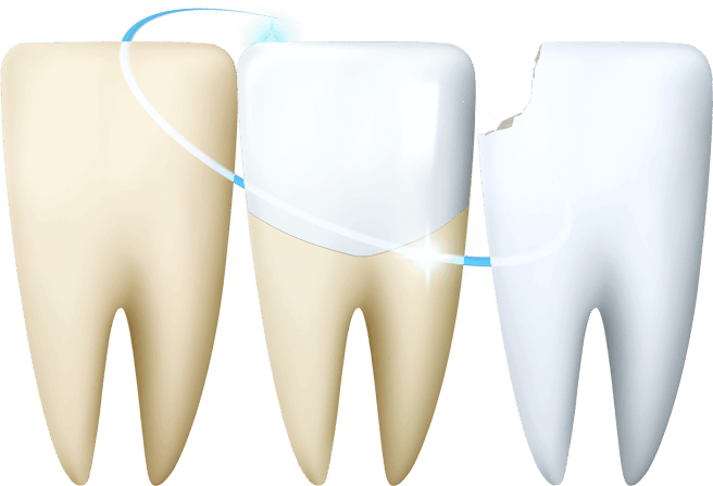 치아성형 이미지